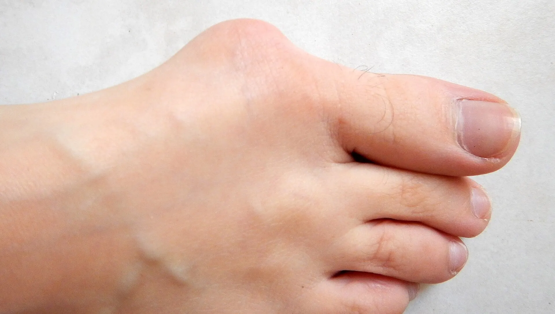 Monturi (hallux valgus) — ce putem și ce nu putem face — îngrijire podologică la MediPedi, 1 Decembrie