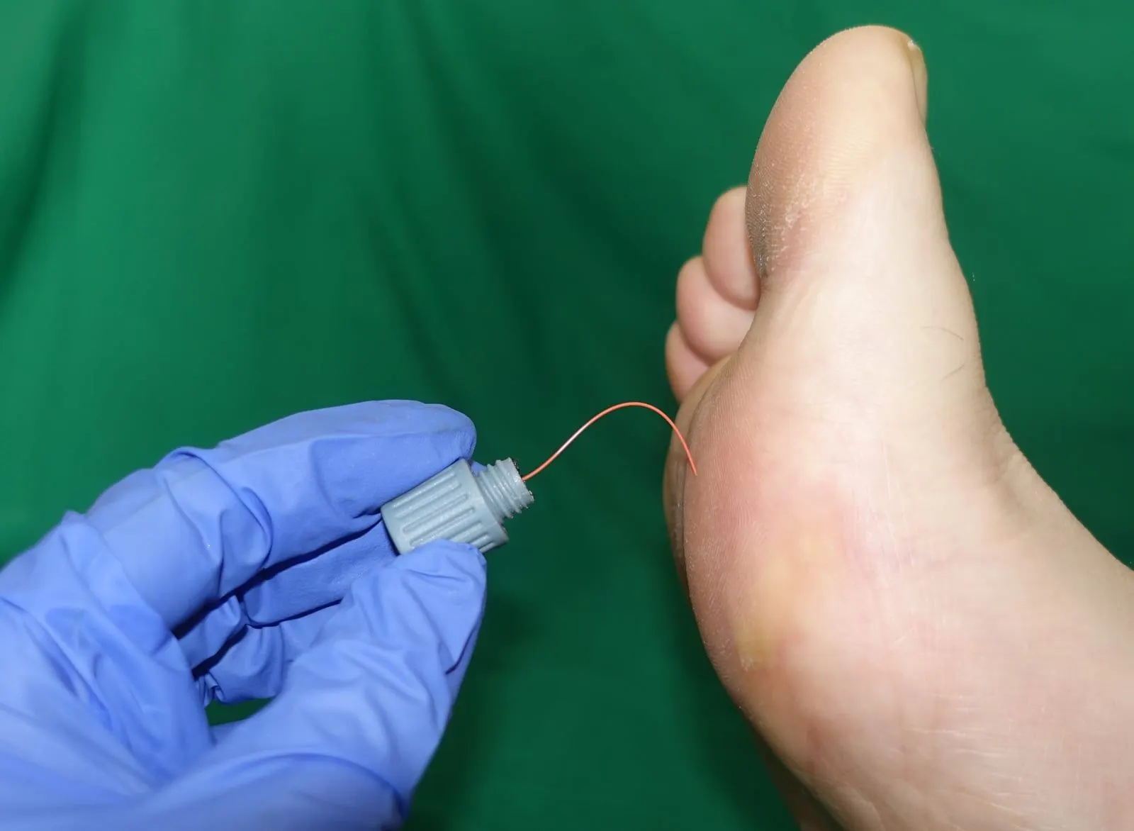 Îngrijirea piciorului diabetic la MediPedi, 1 Decembrie, Ilfov